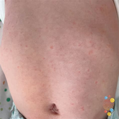 roseola rash leave scars