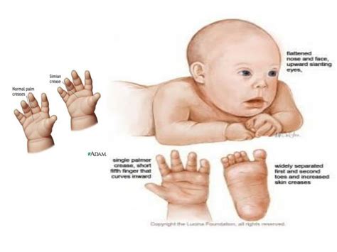 PPT - CHROMOSOMAL ABNORMALITIES PowerPoint Presentation - ID:5719987