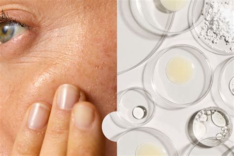 Treating Skin With Azelaic Acid: Before And After - SkinLab