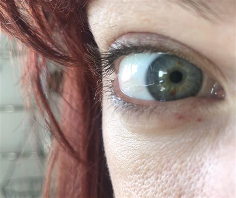 Red spots under eye - what are they and how to get rid of them? : r