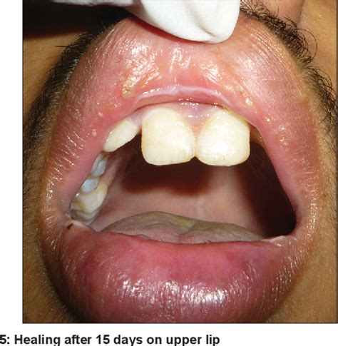 Infectious Cheilitis