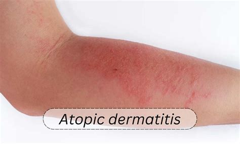 Atopic Dermatitis Bed Sheets at Frank Hansen blog