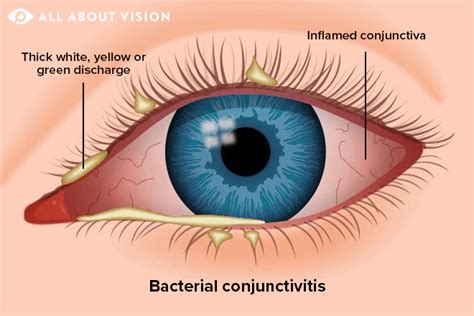 bacterial conjunctivitis