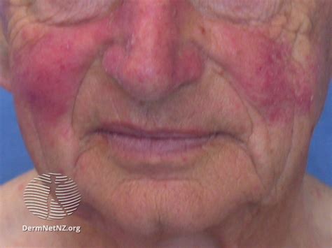 rosacea dermnet nz acne red face nc commons