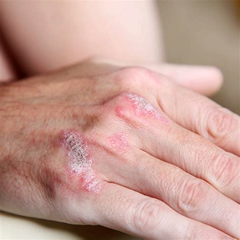 Mild Psoriasis Hands