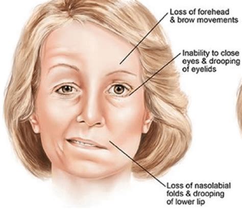 signs bells palsy  healing bells palsy  natural treatments