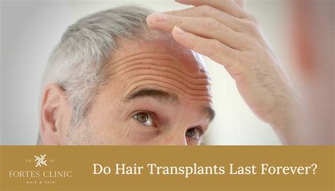 Do Hair Transplants Last Forever? - Fortes Clinic