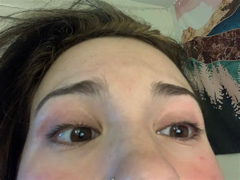 Botched eyelid surgery? : r/PlasticSurgery