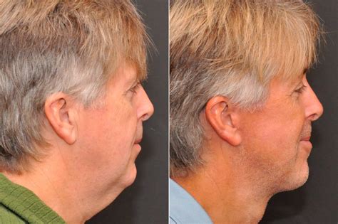 InfluencerGoneWild's Before & After: A Plastic Surgery Nightmare? Image 17