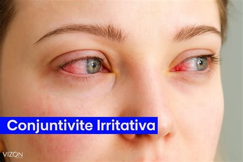 O Que Cura Conjuntivite