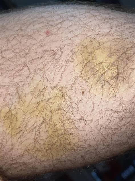 Yellow spots on my skin since my sarm cycle. Is this serious? | Scrolller