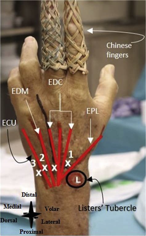Needle Arthroscopy for Bacterial Arthritis of a Native Joint: Surgical