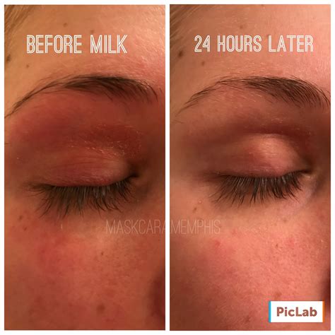 Eye Rash Treatment at Milla Levi blog
