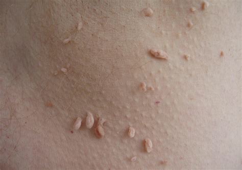 Skin Tags — YourSkin Clinic