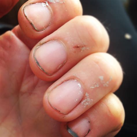 Bacteria Under Nails