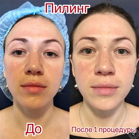 Карбоновый пилинг: отзывы, фото лица до и после