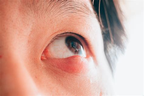 eyelid infection  stye