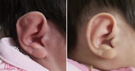 ear molding jandali plastic surgery shareef jandali md