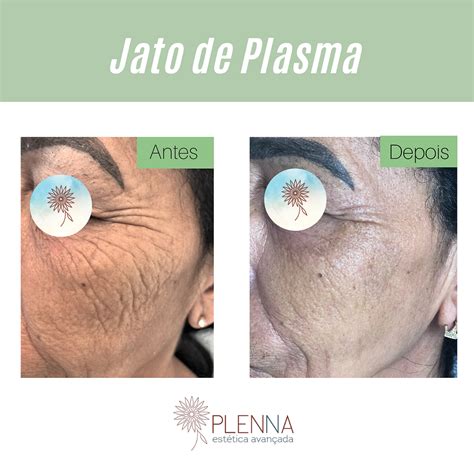 Jato De Plasma Cicatriz Antes E Depois - Jato de Plasma: Rejuvenescimento facial sem cirurgia