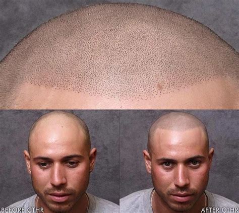 Hair Tattoos For Baldness | POPSUGAR Beauty