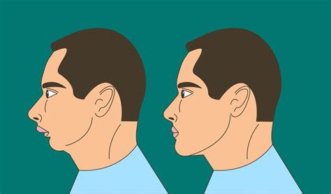 eric davis dental overbite understanding  overbite