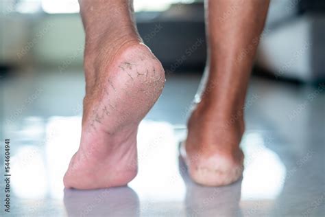 cracked feet dry skin close  asia senior woman cracked feetthe