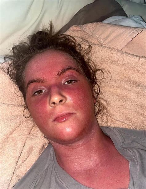 Young woman ‘would do anything to have eczema again’ after steroid