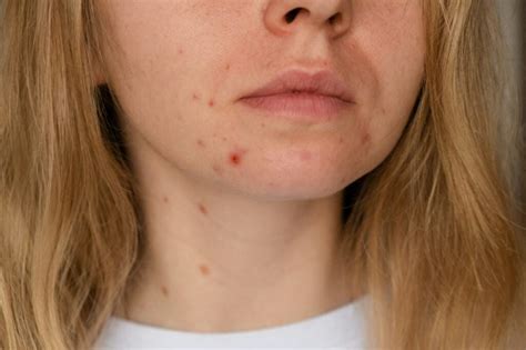 Scar Solutions: Effective Treatments to Fade Facial Scars - Hunter Games Magazine
