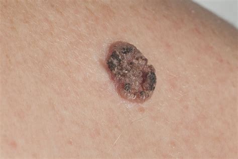 black raised spot  skin