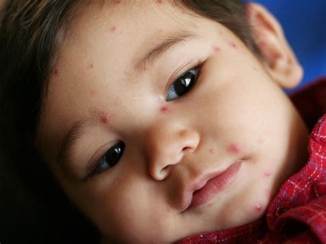 Visual guide to children's rashes and skin conditions | BabyCenter