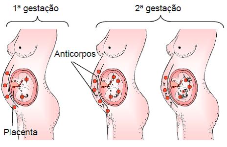 O Que É Eritroblastose Fetal - Eritroblastose Fetal; Doença Hemolítica do Recém-Nascido