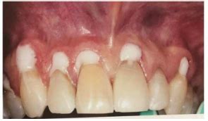 Coagulo De Sangue No Dente Extraido - Extracao De Dente De Coagulo De Fibrina Aço Inoxidável Dental PRF