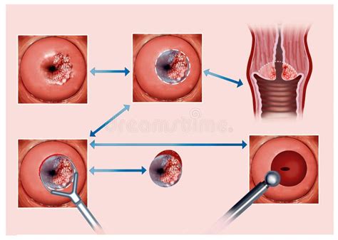O Que É Cauterização Do Utero - Ilustração Que Descreve O Processo De Cauterização Do Colo Do útero ...