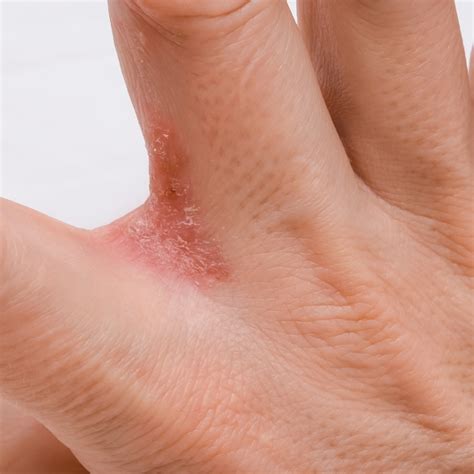 types  eczema  hands