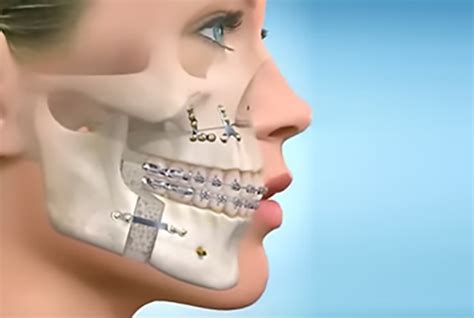 Bucomaxilofacial O Que E - Cirurgia Bucomaxilofacial – Fernando Zahorcsak