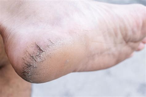 Close up cracked heel further deep cracks and dry flaky skin 54935225