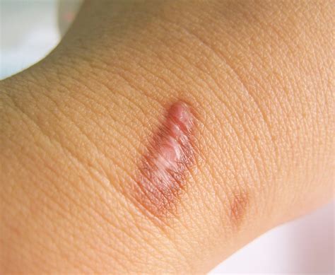 how to know if i have a keloid