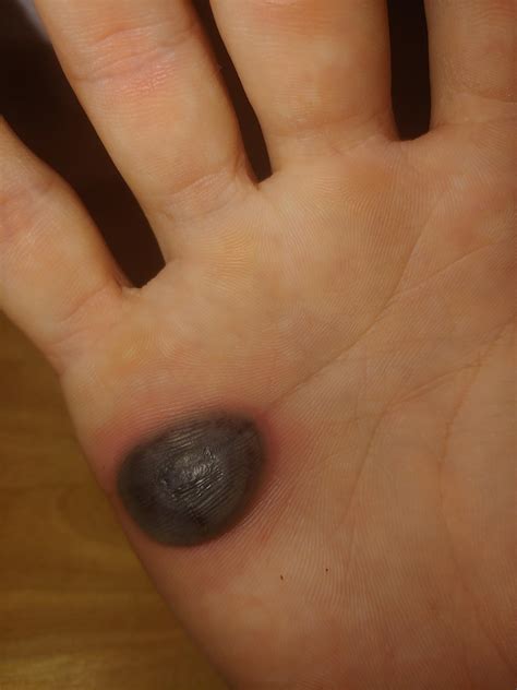 Wart freezing day 5 - Album on Imgur