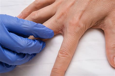 Dyshidrotic Eczema Fingers
