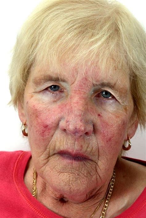 Image:Carcinoid Syndrome (Facial Flushing)-Merck Manual Consumer Version