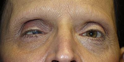 enucleation houston tx ophthalmic plastic surgeons  texas