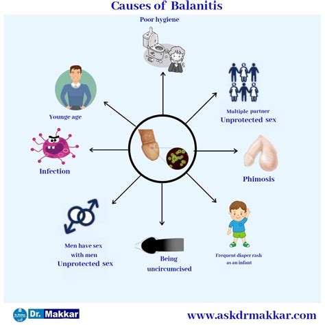 Balanitis Homeopathic Treatment without antibiotics antifungal in ...