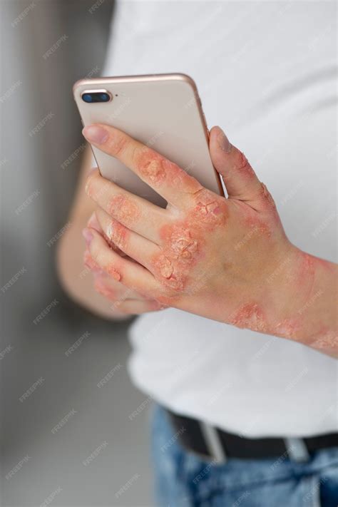 Premium Photo | Hands of patient suffering from psoriasis