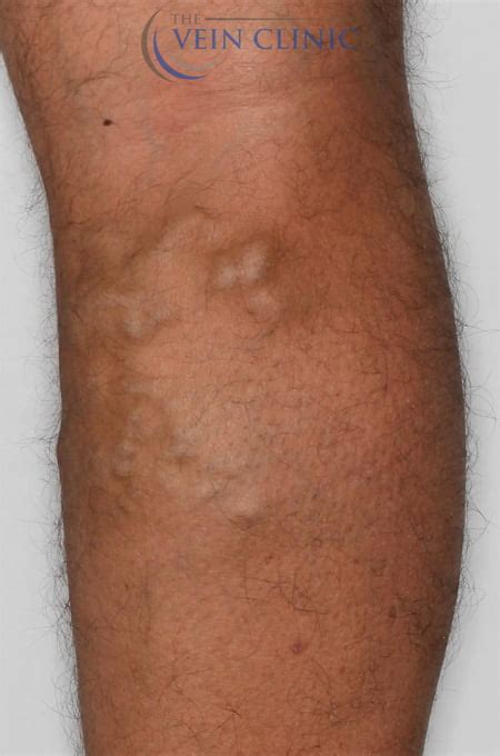 Bulging Leg Veins Treatment | Vein Clinic Perth