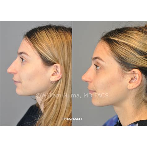 Does Insurance Cover Rhinoplasty?