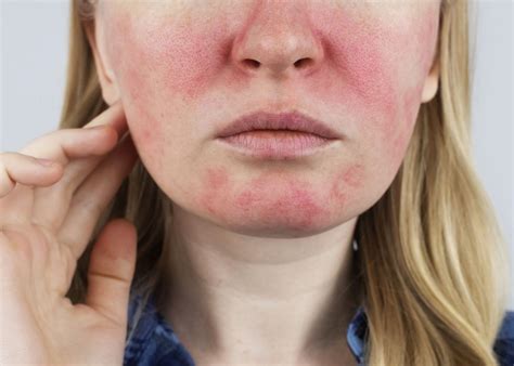 acne  rosacea     katie stewart acne