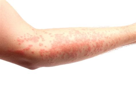 Orticaria cronica in adulti e bambini: cause, immagini,