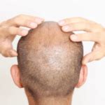 Does Nizoral Cause Hair Loss? What to Know
