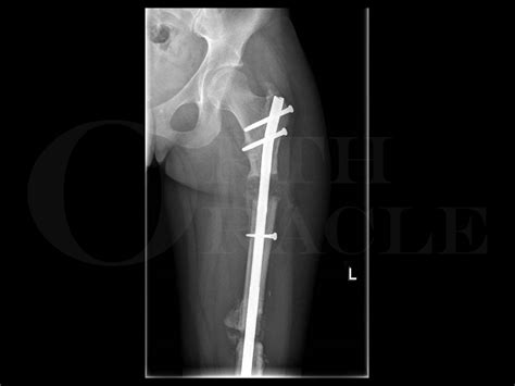 Femoral shaft fracture: Open femoral fracture bone defect treated with ...