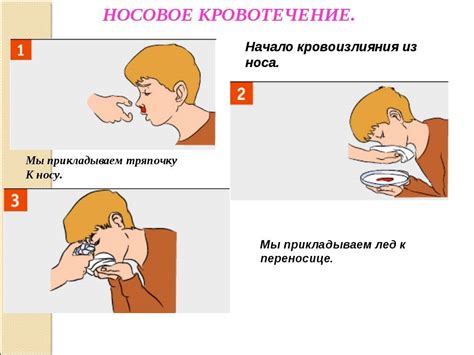 Как быстро остановить кровь из носа самостоятельно в домашних условиях